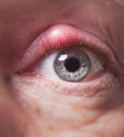 דלקת בשק הדמעות - תמונת המחשה